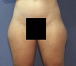 Patient # 69850 Before Photo # 1