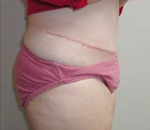 Patient # 77913 After Photo # 4