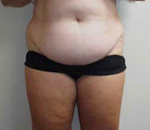 Patient # 77913 Before Photo # 1