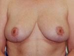 Patient # 64015 After Photo # 2