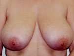Patient # 64015 Before Photo # 1
