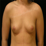 Patient # 78340 Before Photo # 1