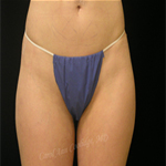 Patient # 22411 After Photo # 2