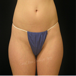 Patient # 22411 Before Photo # 1
