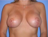 Patient # 51284 After Photo # 2
