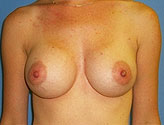 Patient # 94480 After Photo # 2