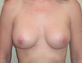 Patient # 24593 After Photo # 2