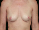 Patient # 24593 Before Photo # 1