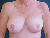 Patient # 17096 After Photo # 2