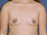 Patient # 50102 Before Photo # 1
