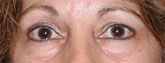 Patient # 49558 Before Photo # 1