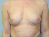 Patient # 44066 Before Photo # 1