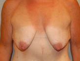 Patient # 53588 Before Photo # 1