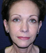 Patient # 60494 After Photo # 2