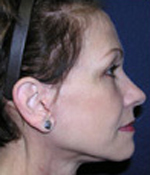 Patient # 60494 After Photo # 4