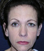 Patient # 60494 Before Photo # 1