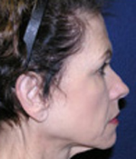 Patient # 60494 Before Photo # 3