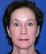 Patient # 25180 After Photo # 2