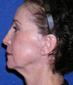 Patient # 25180 After Photo # 4