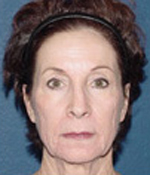 Patient # 25180 Before Photo # 1