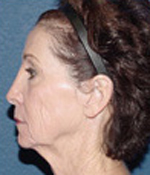 Patient # 25180 Before Photo # 3