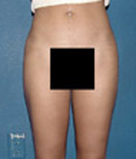 Patient # 99484 After Photo # 2
