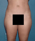 Patient # 99484 Before Photo # 1