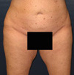 Patient # 93648 After Photo # 2