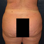 Patient # 93648 After Photo # 4