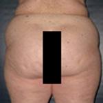 Patient # 93648 Before Photo # 3