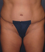 Patient # 85556 After Photo # 2