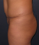 Patient # 85556 After Photo # 4