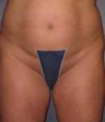 Patient # 85556 Before Photo # 1