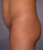 Patient # 85556 Before Photo # 3