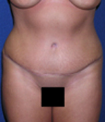 Patient # 31487 After Photo # 2