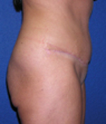 Patient # 31487 After Photo # 4