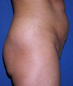 Patient # 31487 Before Photo # 3