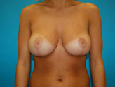 Patient # 35901 After Photo # 2