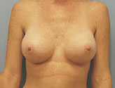 Patient # 21167 After Photo # 2