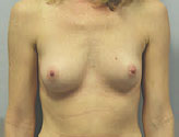 Patient # 21167 Before Photo # 1