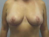 Patient # 83556 After Photo # 2