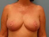 Patient # 58535 After Photo # 2