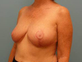Patient # 58535 After Photo # 4