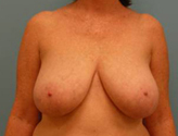 Patient # 58535 Before Photo # 1