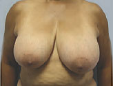 Patient # 59832 Before Photo # 1