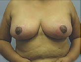 Patient # 82145 After Photo # 2