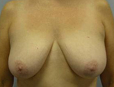Patient # 33813 Before Photo # 1