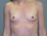 Patient # 71273 Before Photo # 1