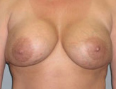 Patient # 42386 After Photo # 2