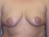 Patient # 42386 Before Photo # 1